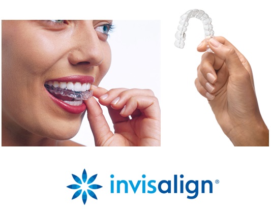 10 things you should know about Invisalign